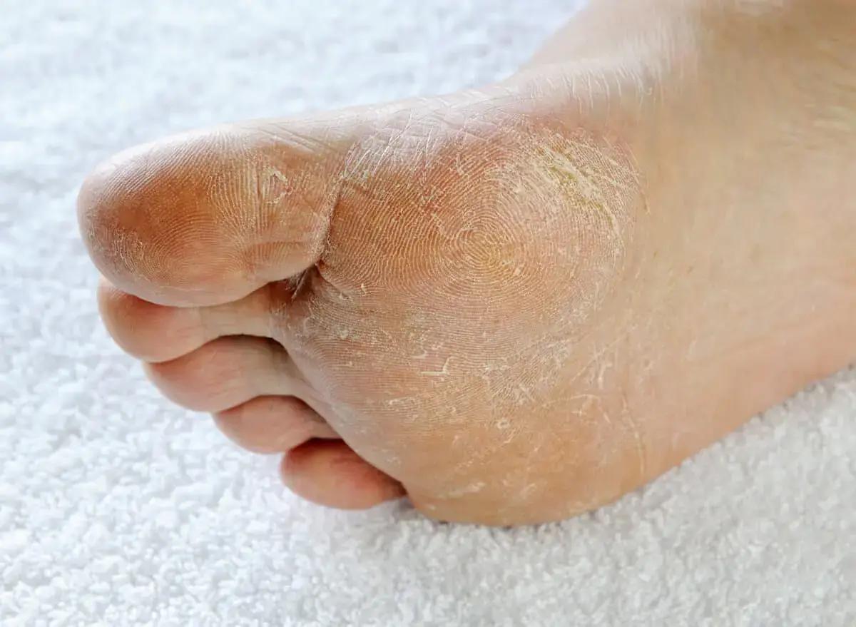 We often focus on facial care, forgetting that the skin on our feet also needs regular and proper moisturizing. This can lead to dryness, tightness, roughness, flaking, itching, or even cracks, which cause discomfort. Many people face these problems regardless of age and gender. The cause may be a lack of systematic care, the influence of external factors, or internal disorders in the body.
In this article, we will examine why the skin on your feet can become dry, how to properly address this issue, and what will help restore a feeling of softness and comfort for a long time.